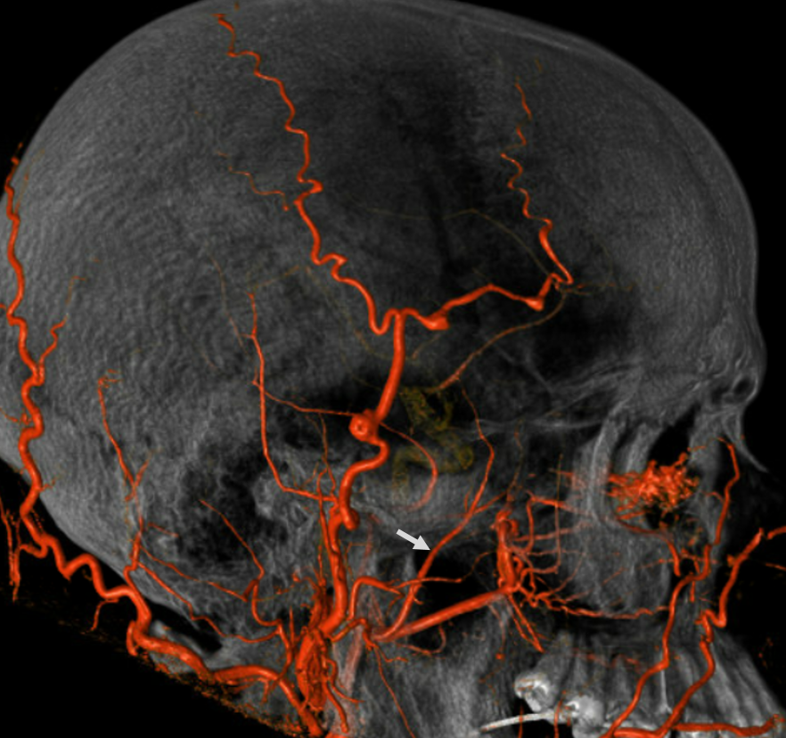 Deep Temporal Arteries 9846